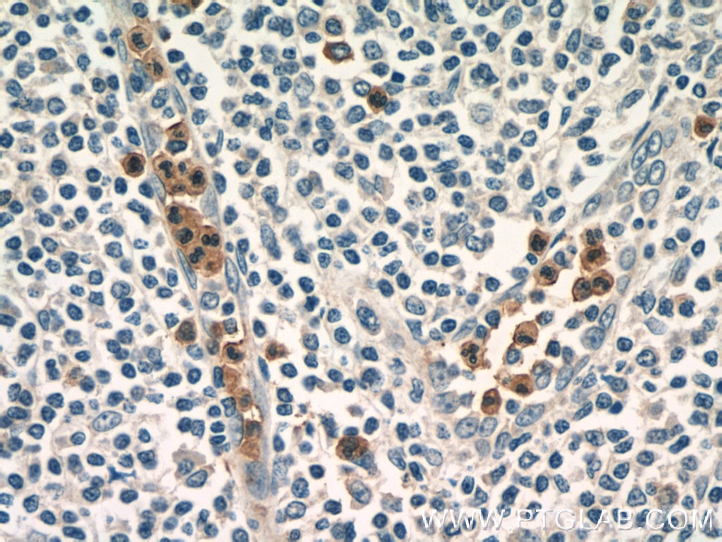 Immunohistochemistry (IHC) staining of human tonsillitis tissue using ASB14 Polyclonal antibody (25300-1-AP)