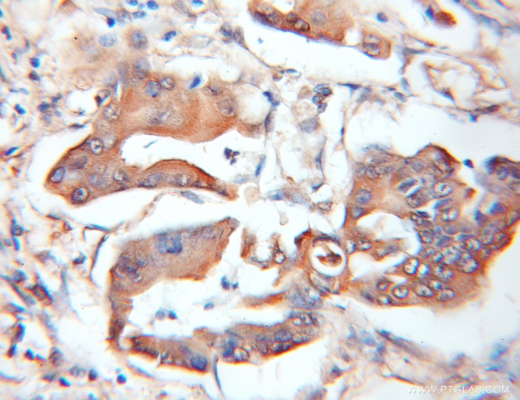 Immunohistochemistry (IHC) staining of human colon cancer tissue using ASB8 Polyclonal antibody (11735-1-AP)