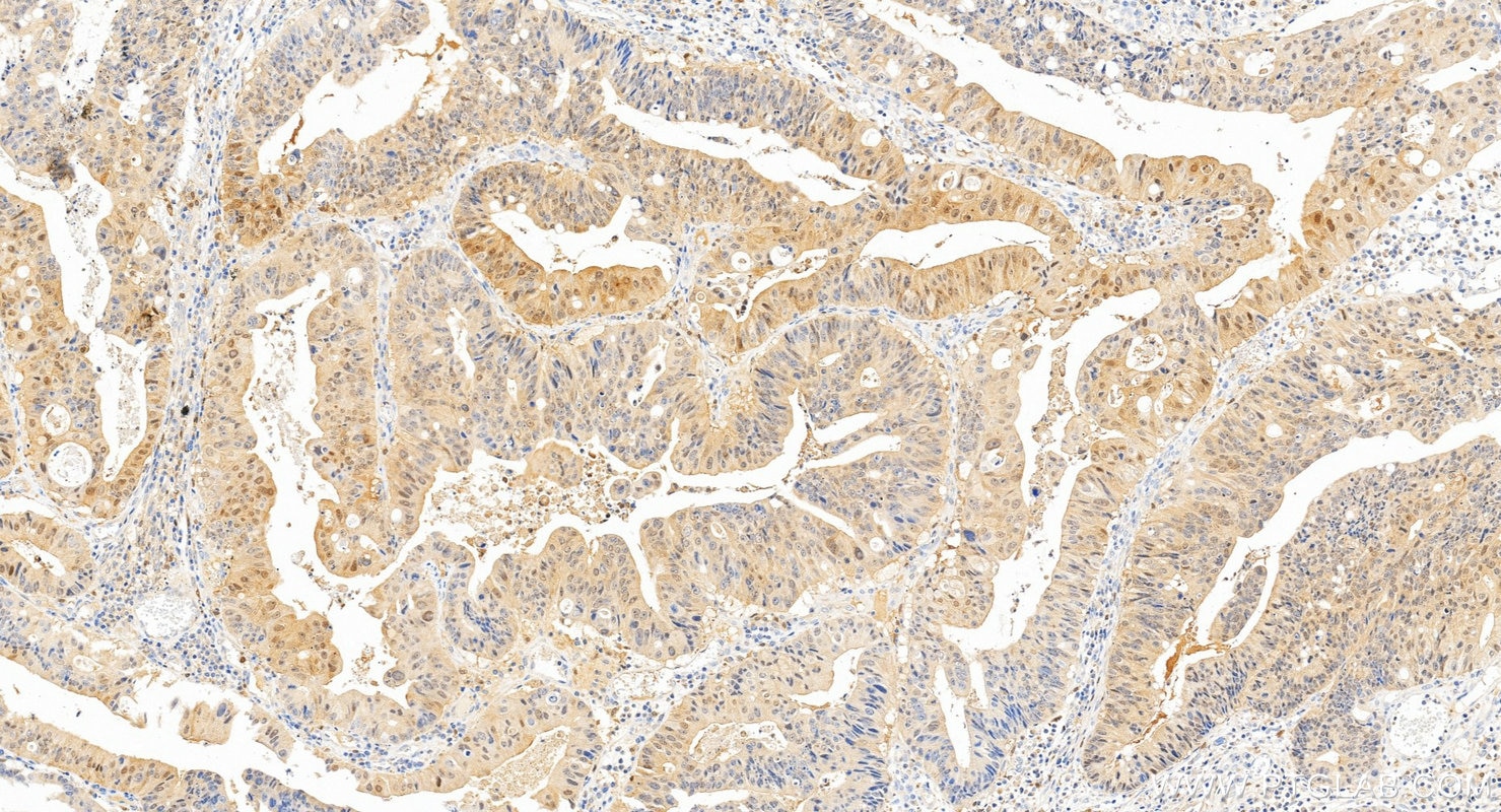 IHC staining of human colon cancer using 88328-1-RR (same clone as 88328-1-PBS) Immunohistochemistry (IHC) staining of human colon cancer tissue using ASC/TMS1 Recombinant monoclonal antibody (88328-1-RR)