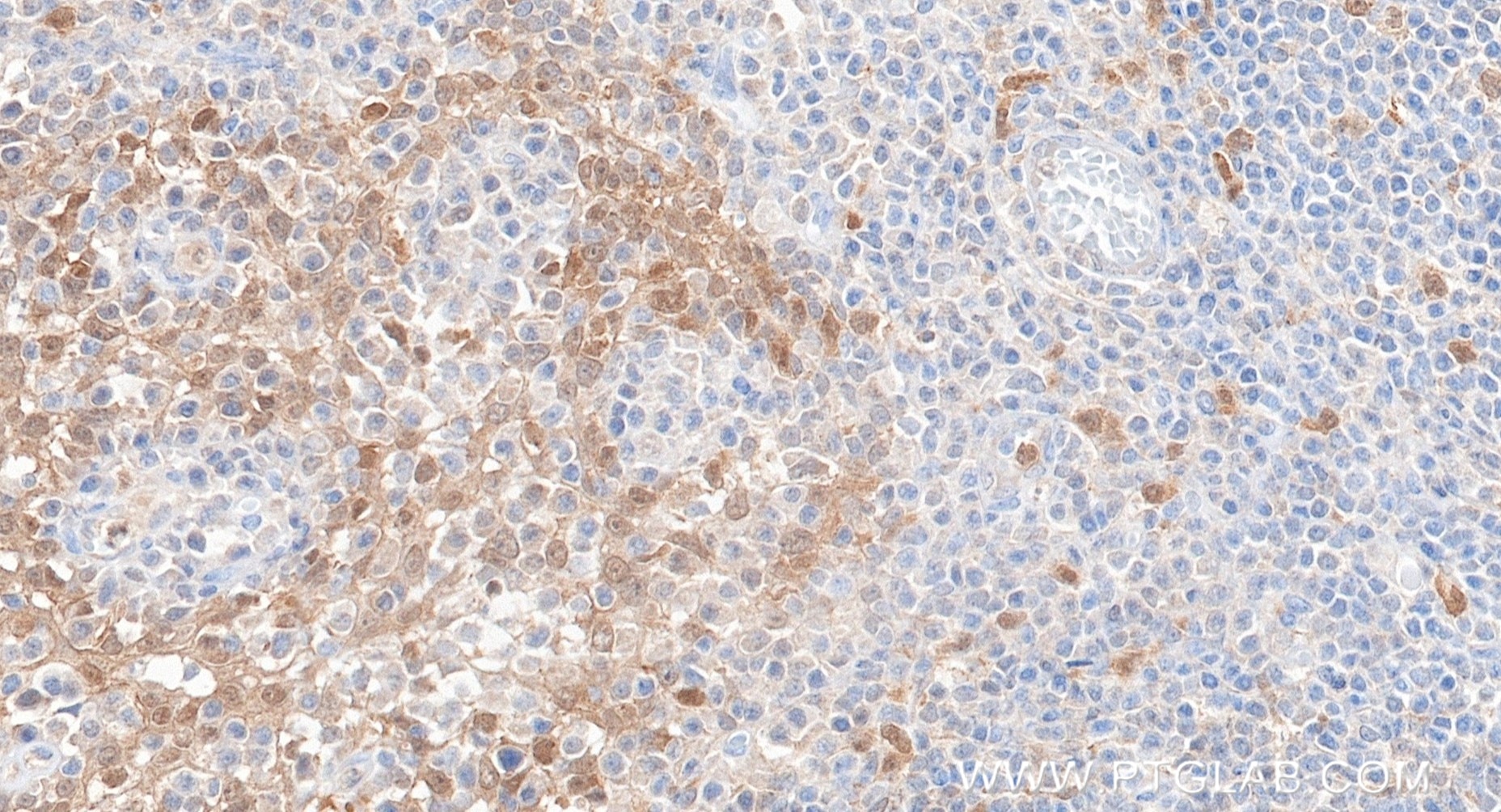 IHC staining of human tonsillitis using 88328-1-RR (same clone as 88328-1-PBS) Immunohistochemistry (IHC) staining of human tonsillitis tissue using ASC/TMS1 Recombinant monoclonal antibody (88328-1-RR)
