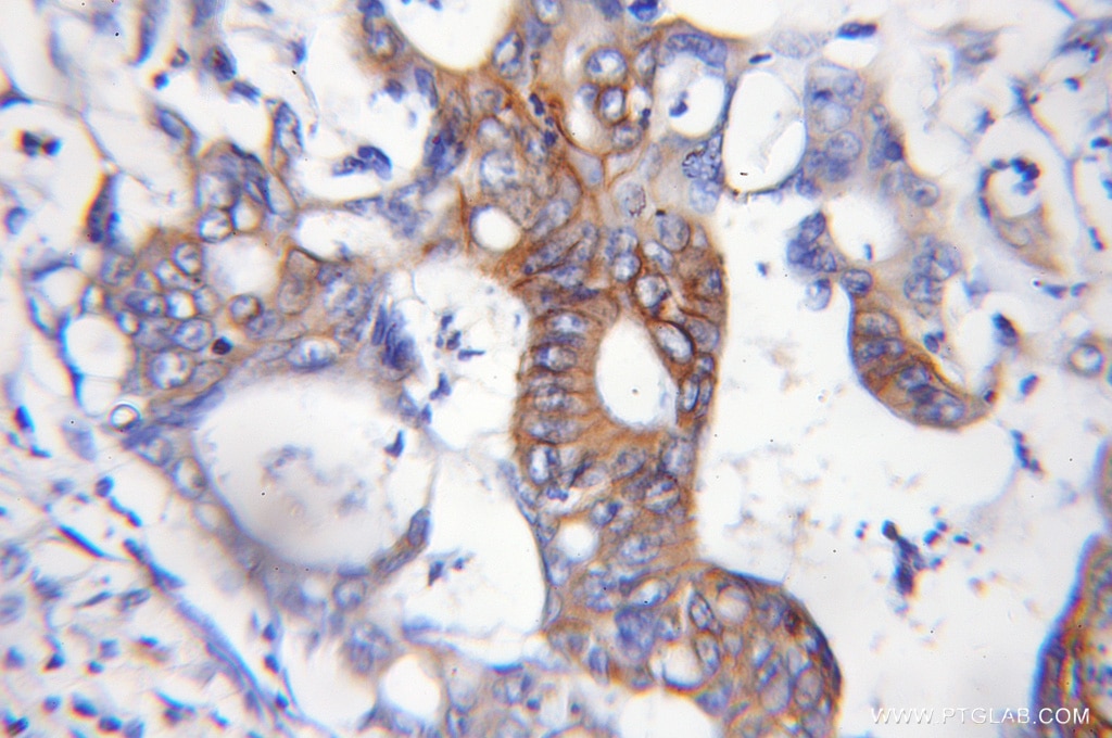 Immunohistochemistry (IHC) staining of human colon cancer tissue using ASCC2 Polyclonal antibody (11529-1-AP)