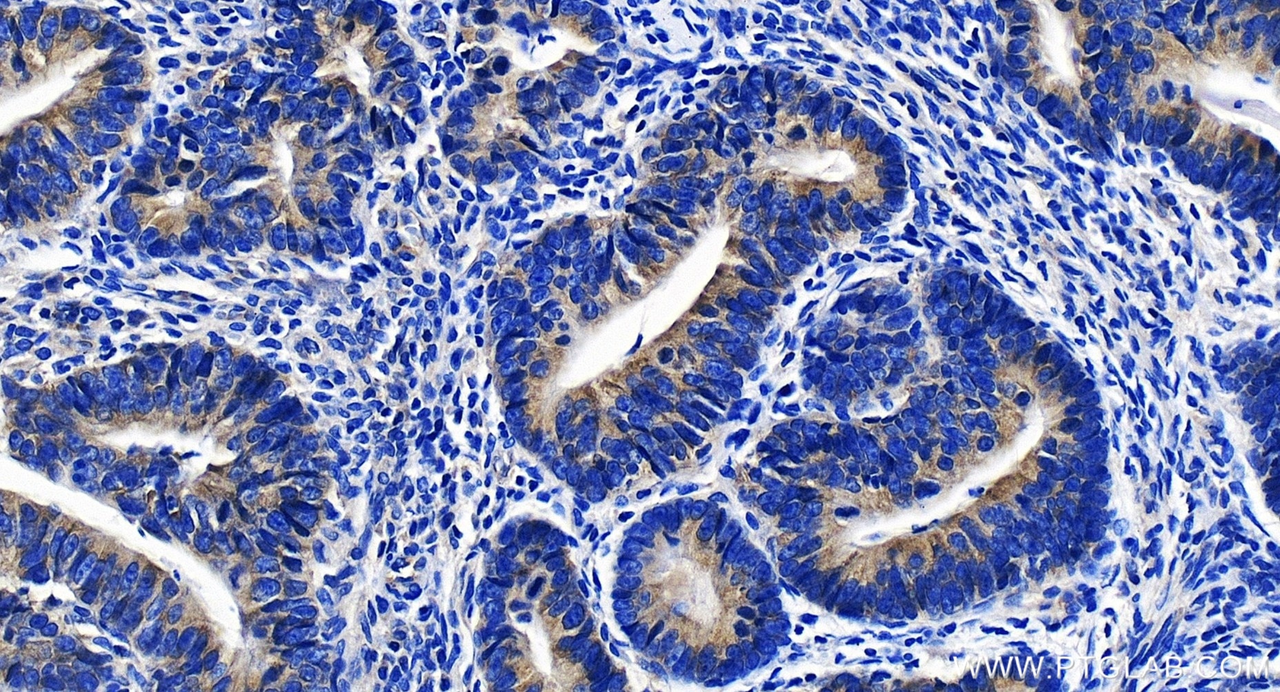 Immunohistochemistry (IHC) staining of human colon cancer tissue using ASCC2 Recombinant antibody (86086-1-RR)