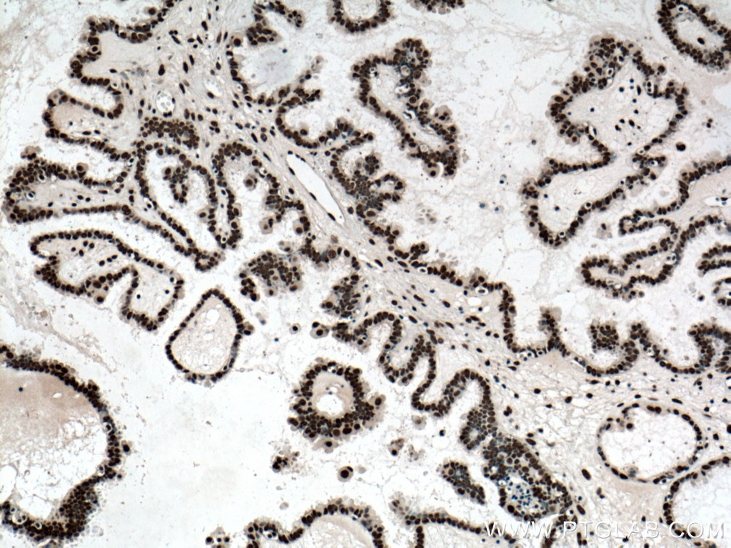 Immunohistochemistry (IHC) staining of human ovary tumor tissue using ASF/SF2 Monoclonal antibody (66671-1-Ig)