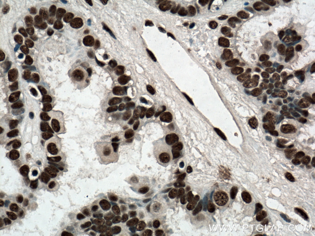 Immunohistochemistry (IHC) staining of human ovary tumor tissue using ASF/SF2 Monoclonal antibody (66671-1-Ig)