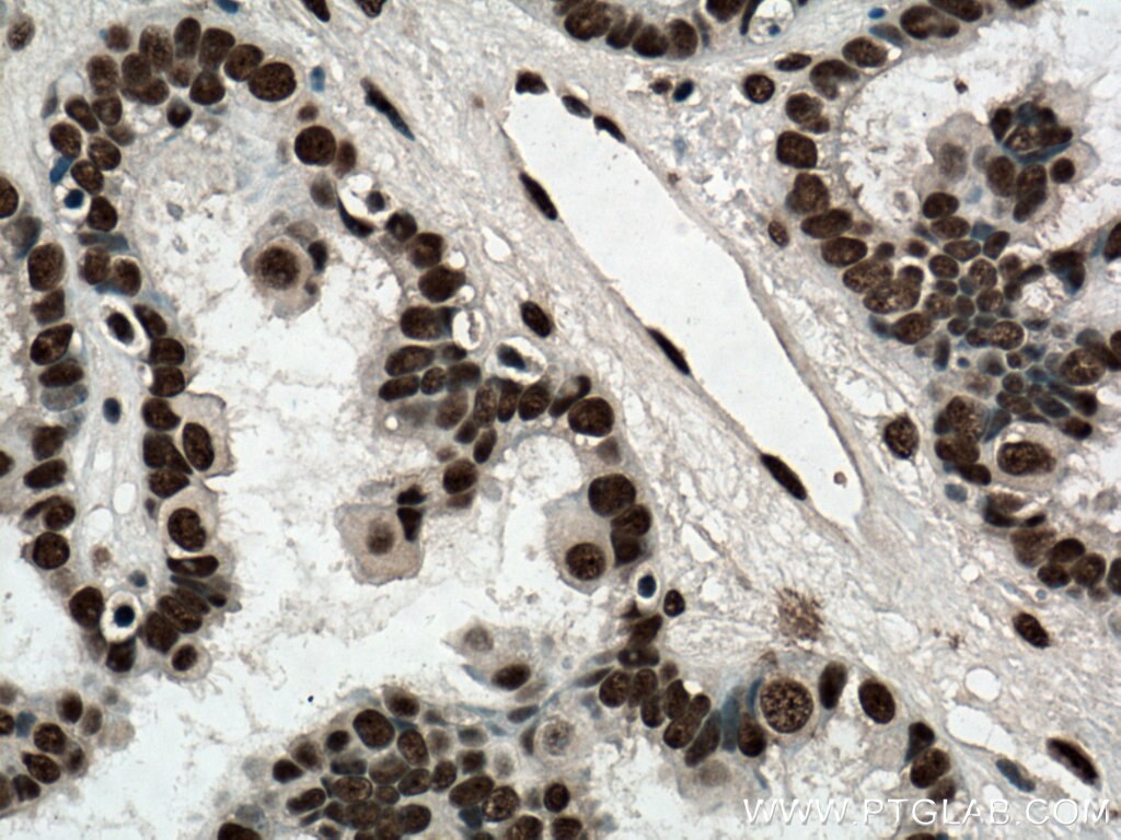 Immunohistochemistry (IHC) staining of human ovary tumor tissue using ASF/SF2 Monoclonal antibody (66671-1-Ig)