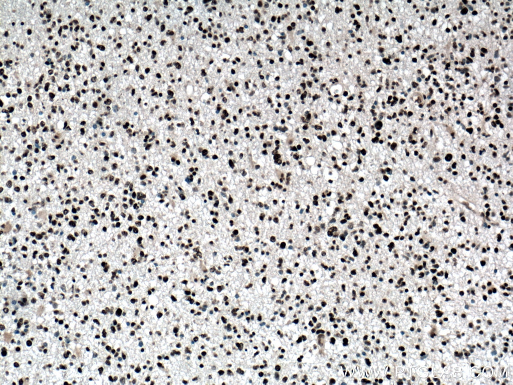 Immunohistochemistry (IHC) staining of human gliomas tissue using ASF/SF2 Monoclonal antibody (66671-1-Ig)