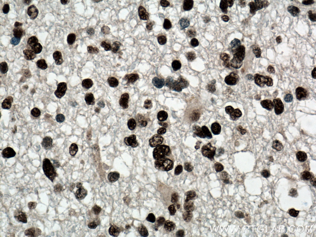 IHC staining of human gliomas using 66671-1-Ig