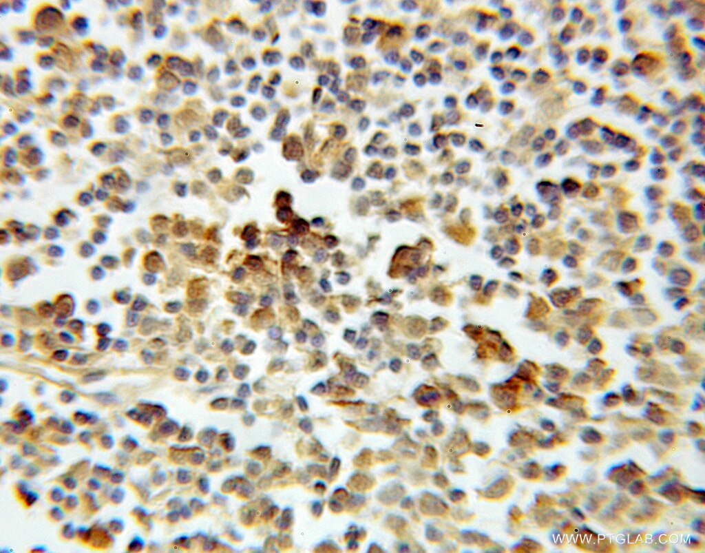 Immunohistochemistry (IHC) staining of human lymphoma tissue using ASF1A Polyclonal antibody (10784-1-AP)