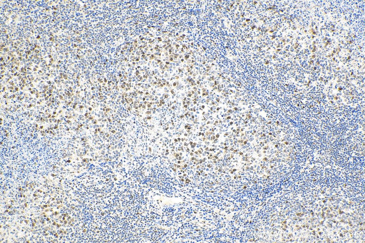 Immunohistochemistry (IHC) staining of human lymphoma tissue using ASF1A/B Polyclonal antibody (11011-1-AP)