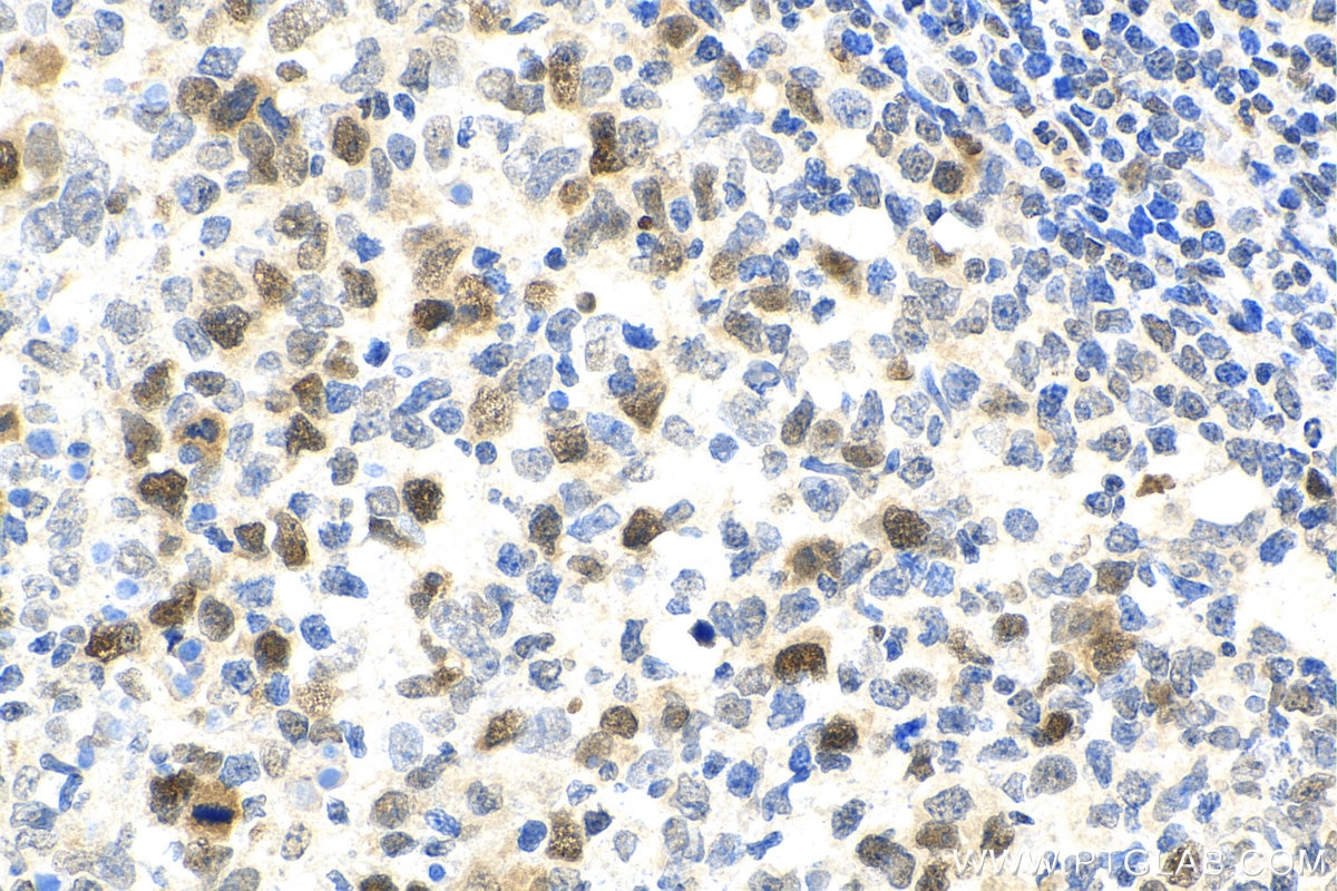 Immunohistochemistry (IHC) staining of human lymphoma tissue using ASF1A/B Polyclonal antibody (11011-1-AP)