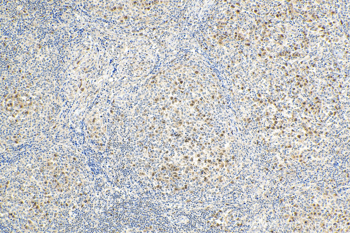 Immunohistochemistry (IHC) staining of human lymphoma tissue using ASF1B-specific Polyclonal antibody (22258-1-AP)