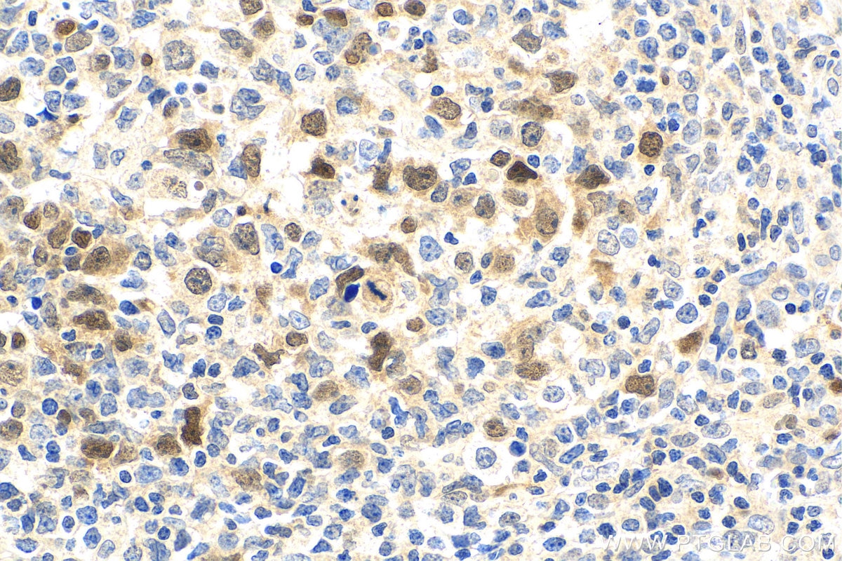 Immunohistochemistry (IHC) staining of human lymphoma tissue using ASF1B-specific Polyclonal antibody (22258-1-AP)