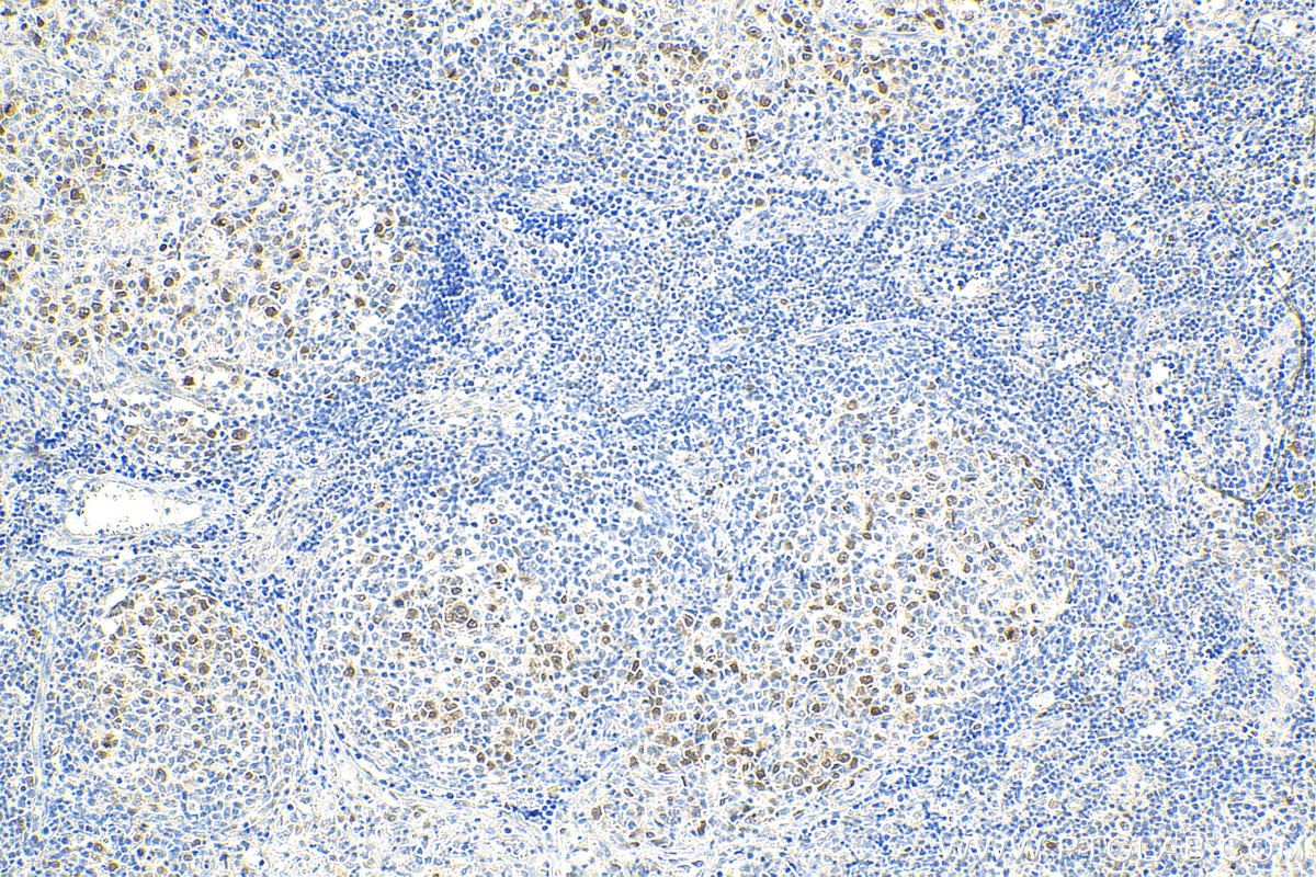 IHC staining of human lymphoma using 22258-1-AP