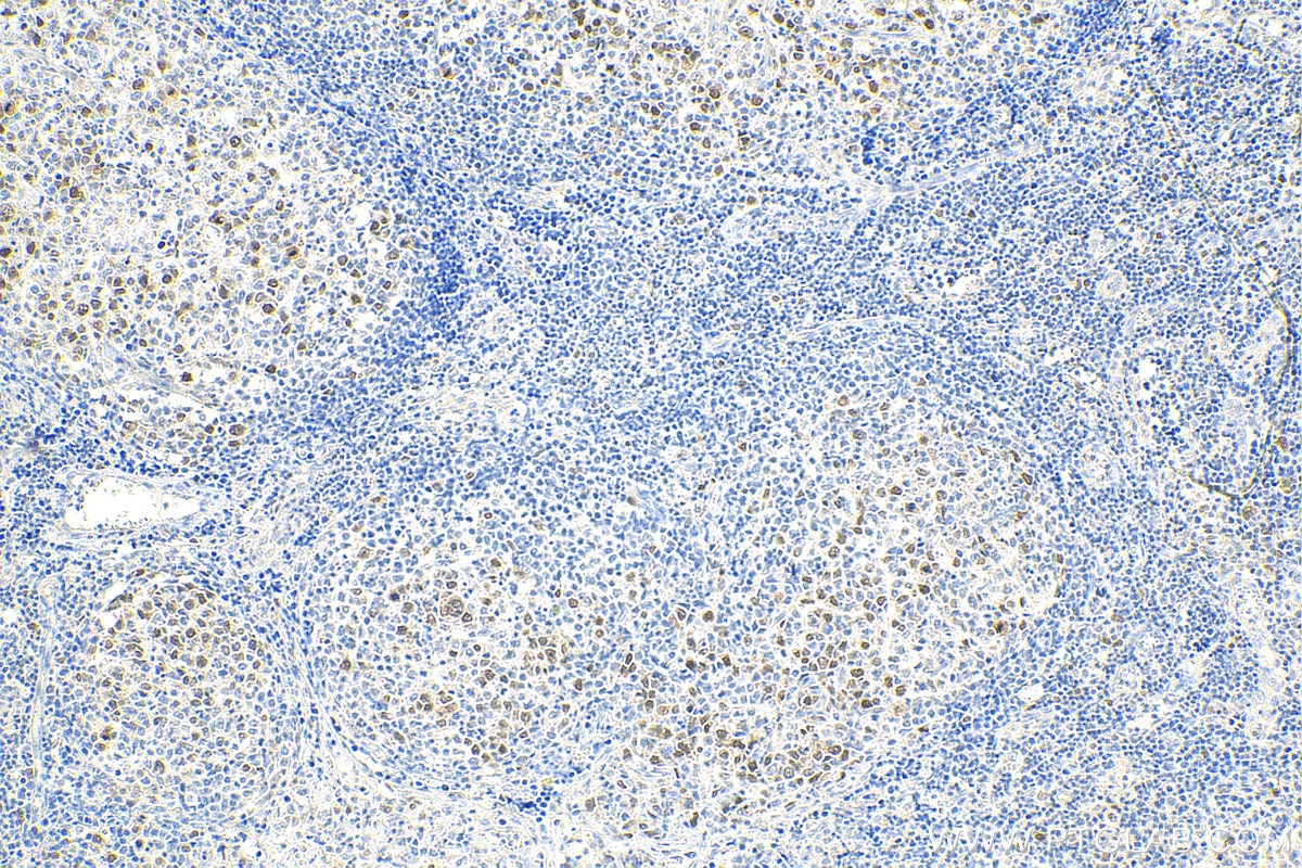Immunohistochemistry (IHC) staining of human lymphoma tissue using ASF1B-specific Polyclonal antibody (22258-1-AP)