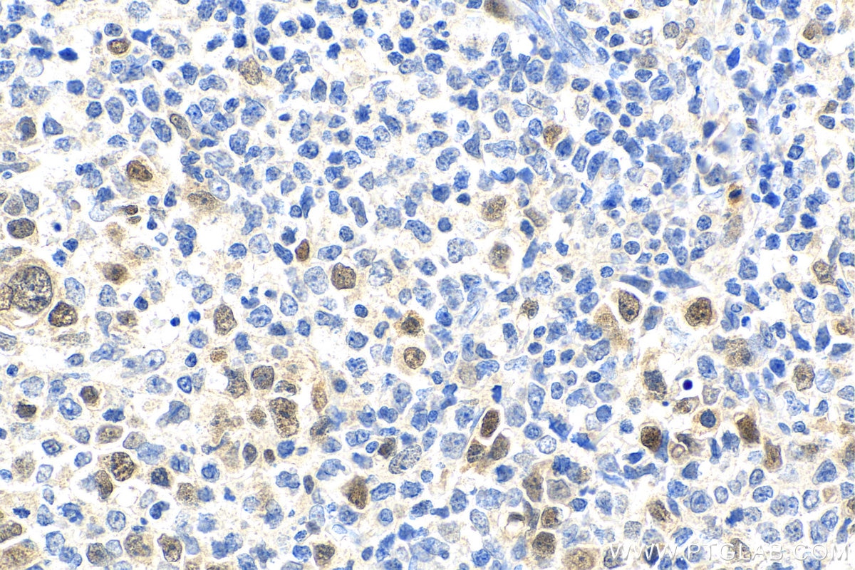 Immunohistochemistry (IHC) staining of human lymphoma tissue using ASF1B-specific Polyclonal antibody (22258-1-AP)