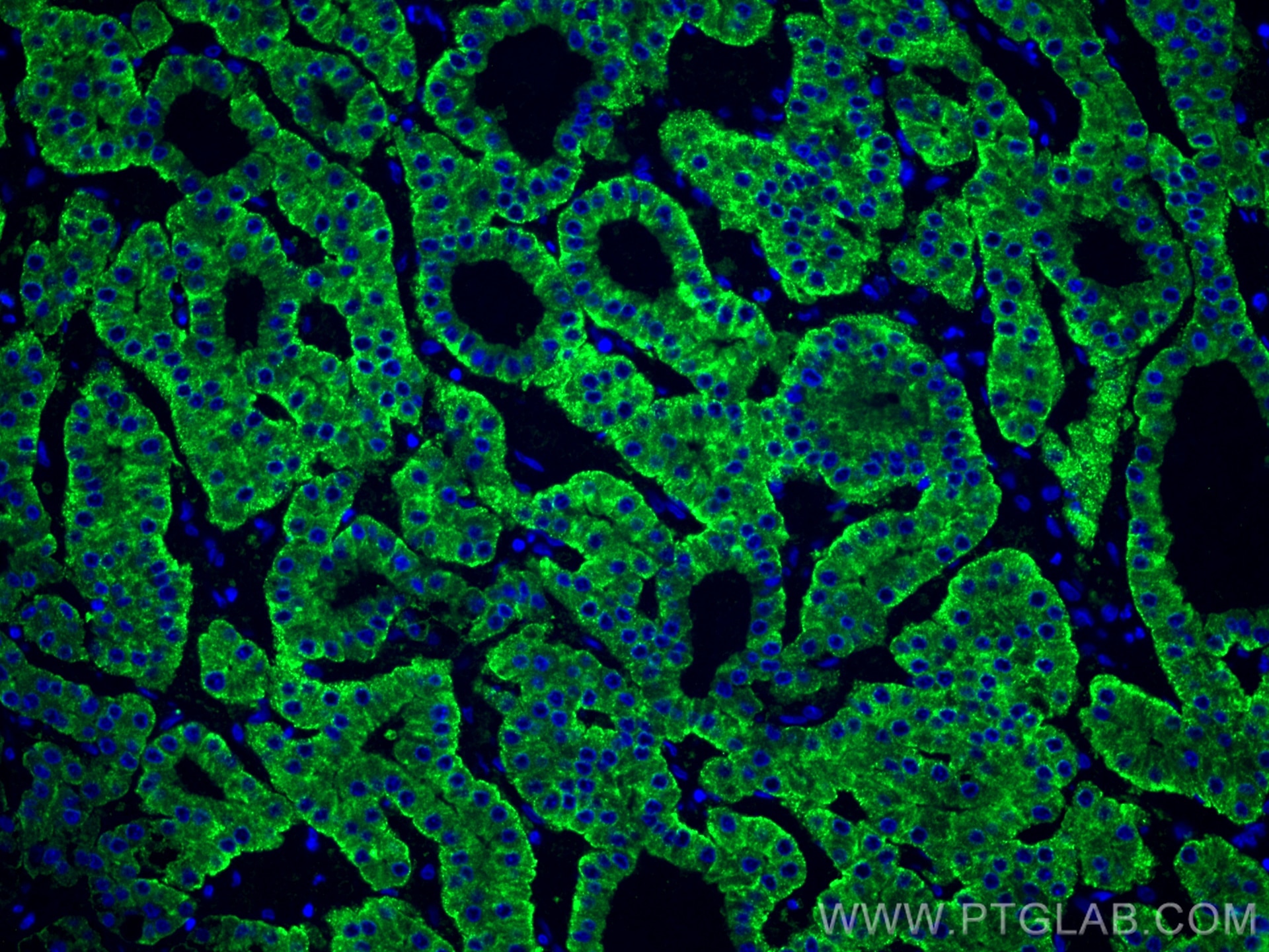 Immunofluorescence (IF) / fluorescent staining of human liver cancer tissue using ASGR1 Polyclonal antibody (11739-1-AP)