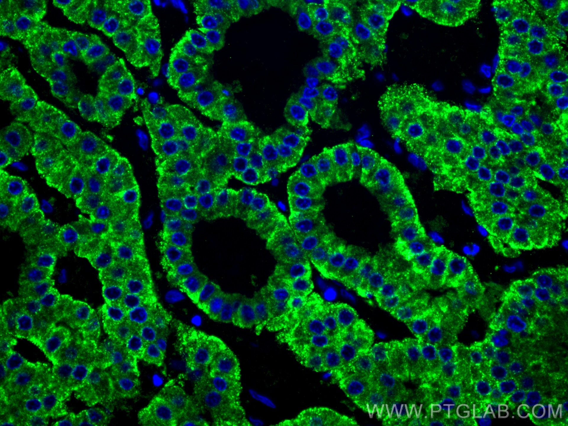 Immunofluorescence (IF) / fluorescent staining of human liver cancer tissue using ASGR1 Polyclonal antibody (11739-1-AP)