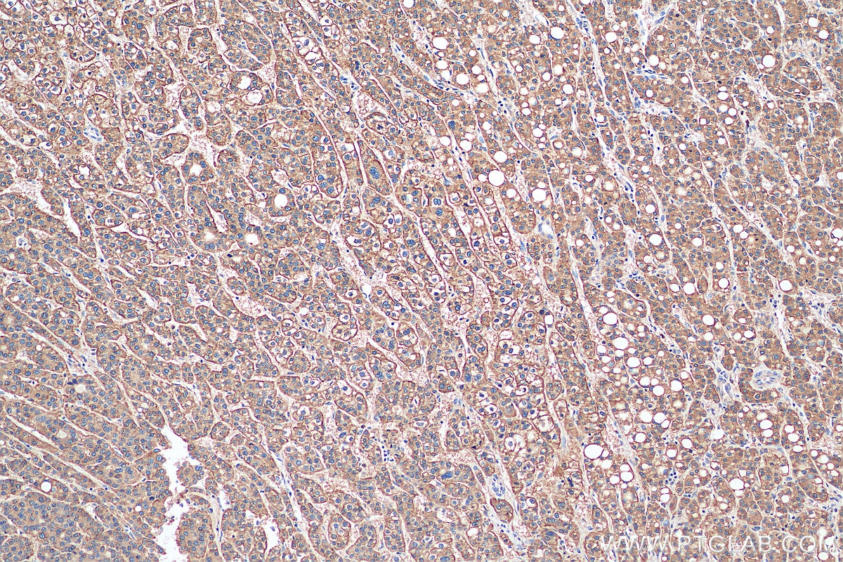 Immunohistochemistry (IHC) staining of human liver cancer tissue using ASGR1 Polyclonal antibody (11739-1-AP)