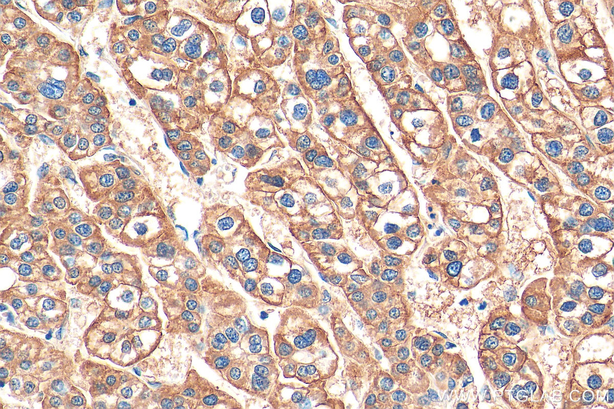 Immunohistochemistry (IHC) staining of human liver cancer tissue using ASGR1 Polyclonal antibody (11739-1-AP)