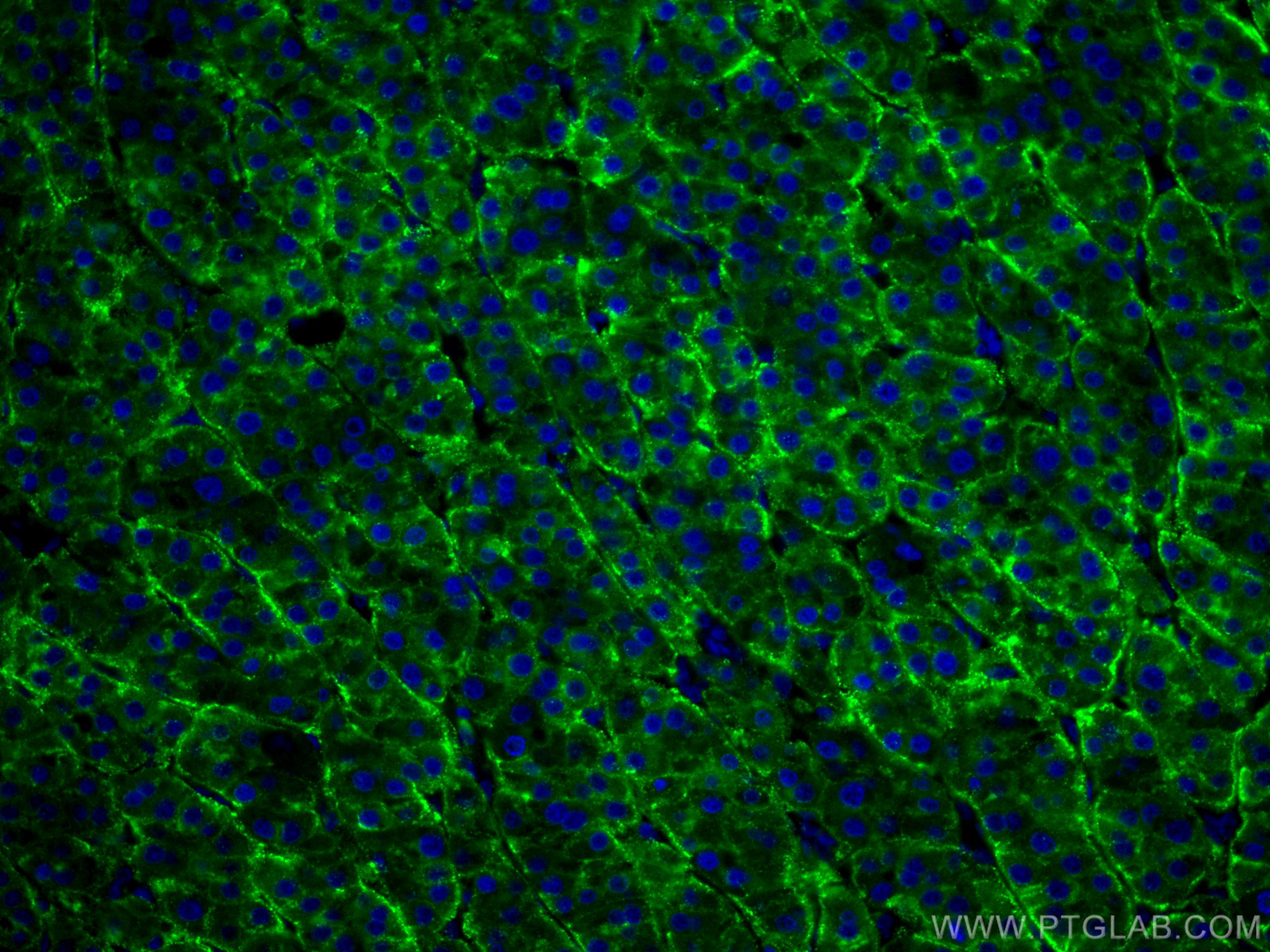 Immunofluorescence (IF) / fluorescent staining of human liver cancer tissue using CoraLite® Plus 488-conjugated ASGR1 Polyclonal ant (CL488-11739)