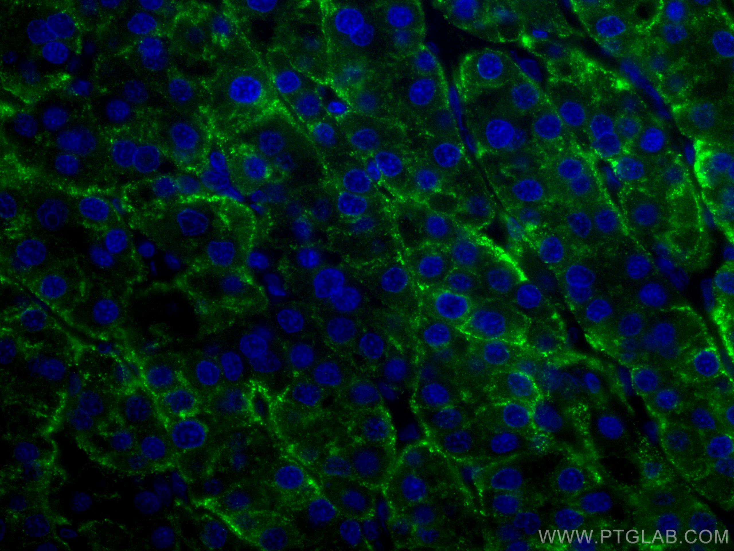 Immunofluorescence (IF) / fluorescent staining of human liver cancer tissue using CoraLite® Plus 488-conjugated ASGR1 Polyclonal ant (CL488-11739)