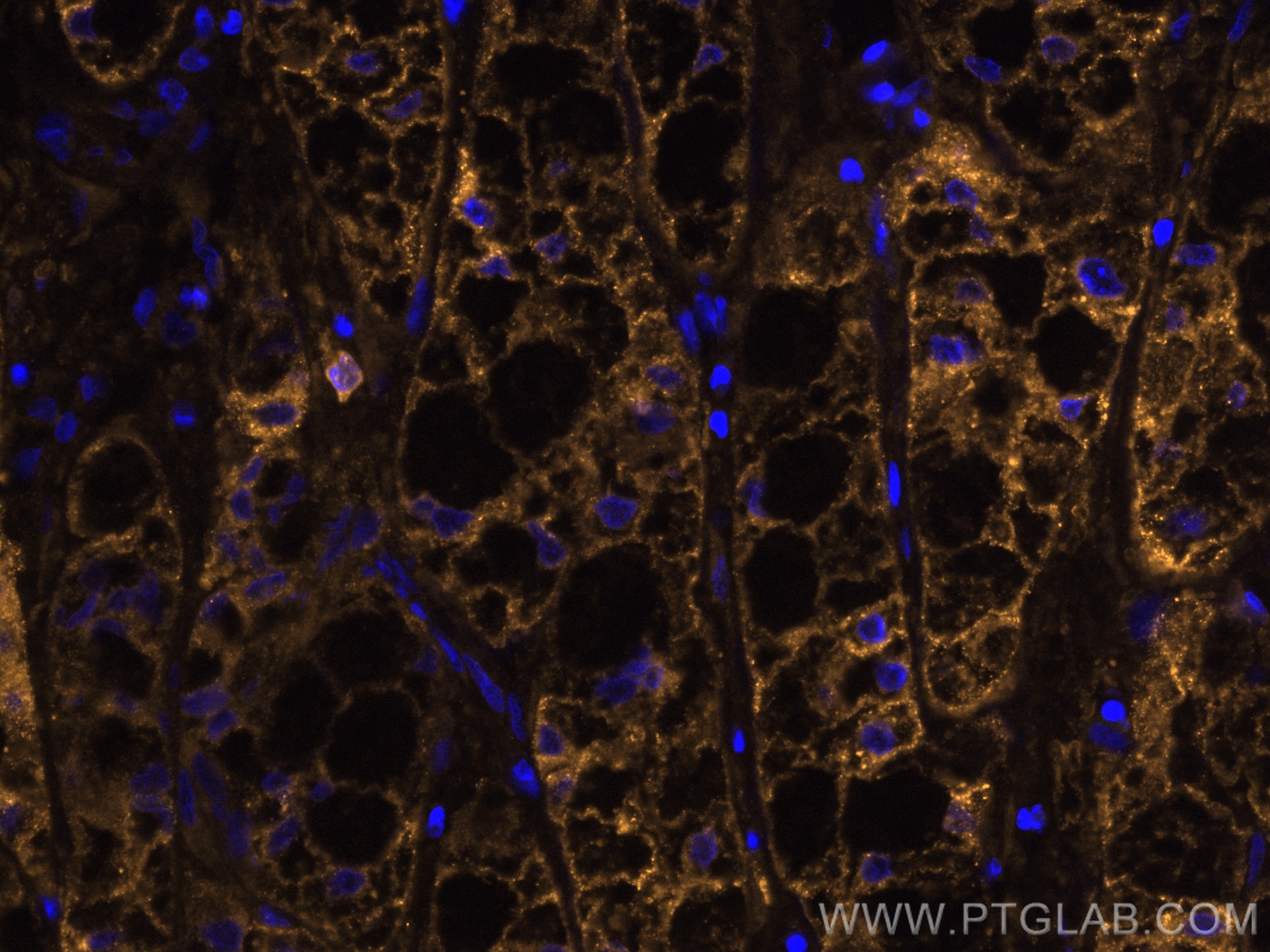 Immunofluorescence (IF) / fluorescent staining of human liver cancer tissue using CoraLite®555-conjugated ASGR1 Polyclonal antibody (CL555-11739)