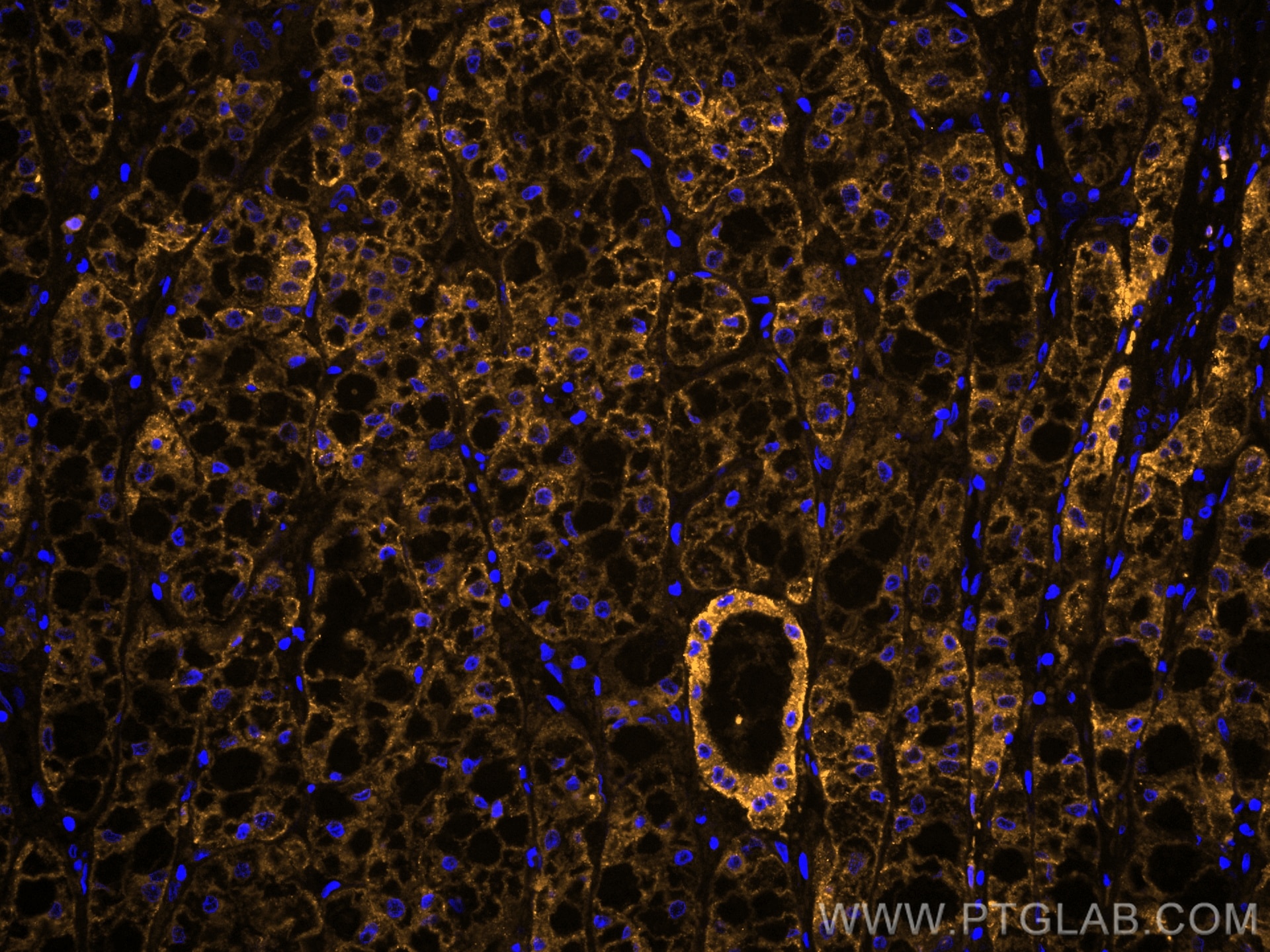 Immunofluorescence (IF) / fluorescent staining of human liver cancer tissue using CoraLite®555-conjugated ASGR1 Polyclonal antibody (CL555-11739)