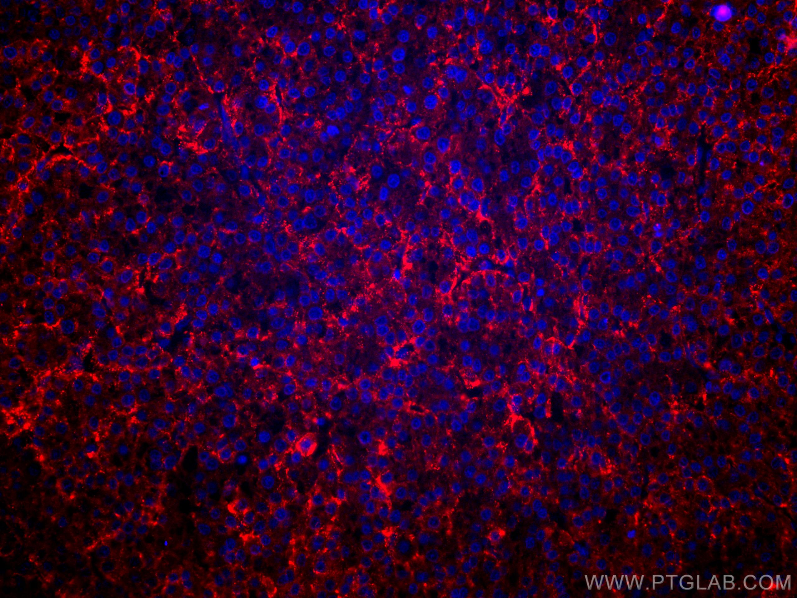 Immunofluorescence (IF) / fluorescent staining of human liver cancer tissue using CoraLite®594-conjugated ASGR1 Polyclonal antibody (CL594-11739)