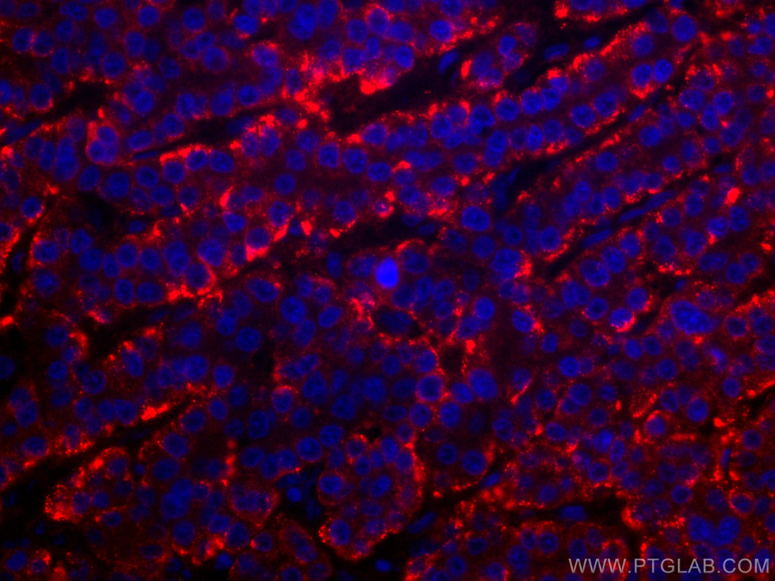 IF Staining of human liver cancer using CL594-11739