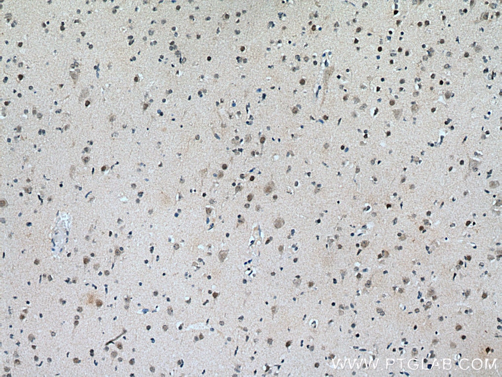 Immunohistochemistry (IHC) staining of human gliomas tissue using ASH2L Polyclonal antibody (12331-1-AP)