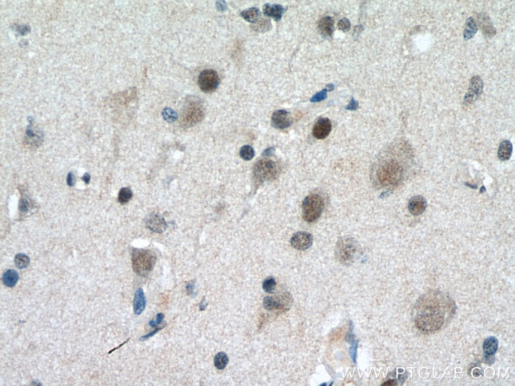 Immunohistochemistry (IHC) staining of human gliomas tissue using ASH2L Polyclonal antibody (12331-1-AP)
