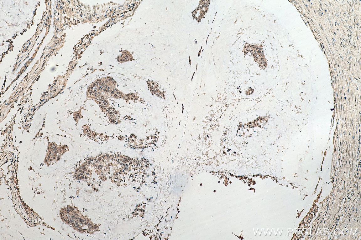 Immunohistochemistry (IHC) staining of human colon cancer tissue using ASH2L Monoclonal antibody (67859-1-Ig)