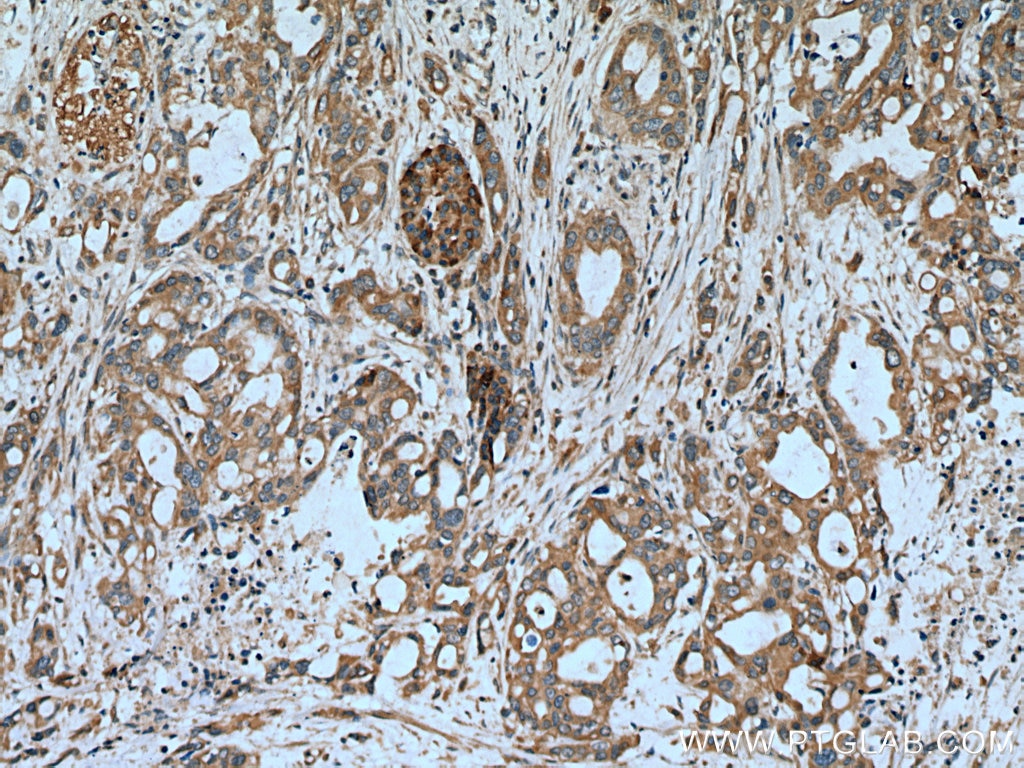 Immunohistochemistry (IHC) staining of human pancreas cancer tissue using ASIC1 Polyclonal antibody (27235-1-AP)