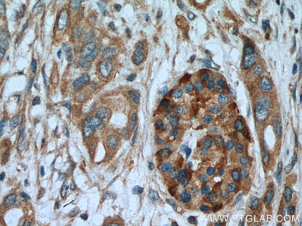 Immunohistochemistry (IHC) staining of human pancreas cancer tissue using ASIC1 Polyclonal antibody (27235-1-AP)