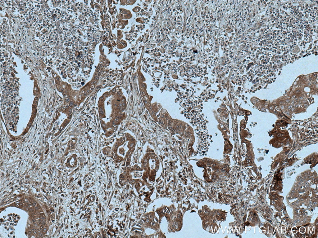 Immunohistochemistry (IHC) staining of human pancreas cancer tissue using ASK1 Polyclonal antibody (28201-1-AP)