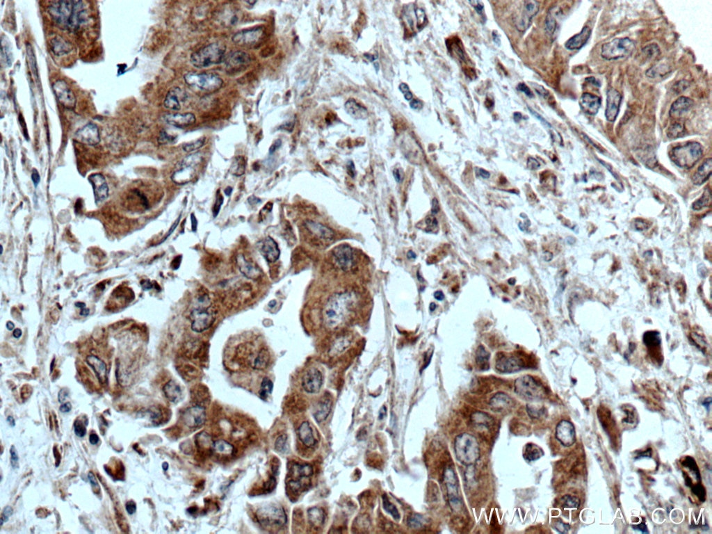 Immunohistochemistry (IHC) staining of human pancreas cancer tissue using ASK1 Polyclonal antibody (28201-1-AP)
