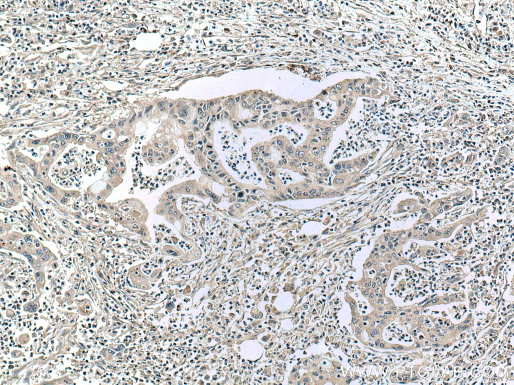 Immunohistochemistry (IHC) staining of human pancreas cancer tissue using ASK1 Monoclonal antibody (67072-1-Ig)