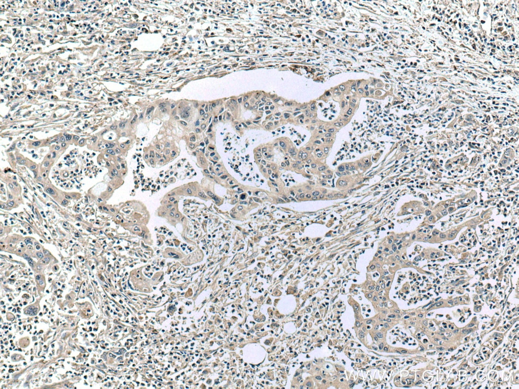 IHC staining of human pancreas cancer using 67072-1-Ig