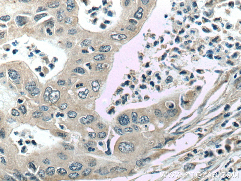 Immunohistochemistry (IHC) staining of human pancreas cancer tissue using ASK1 Monoclonal antibody (67072-1-Ig)