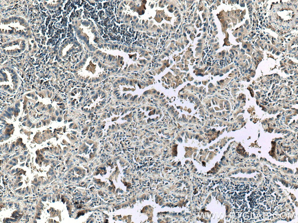 Immunohistochemistry (IHC) staining of human lung cancer tissue using ASK1 Monoclonal antibody (67072-1-Ig)