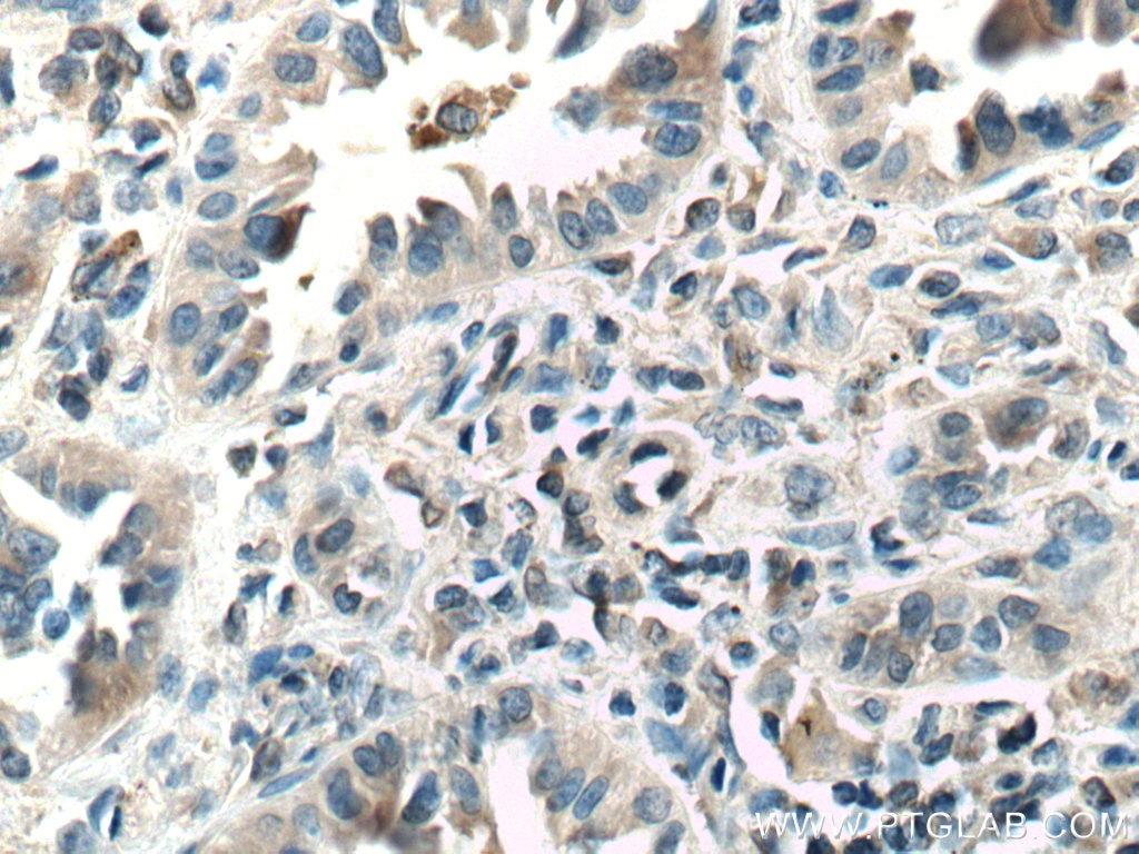 Immunohistochemistry (IHC) staining of human lung cancer tissue using ASK1 Monoclonal antibody (67072-1-Ig)