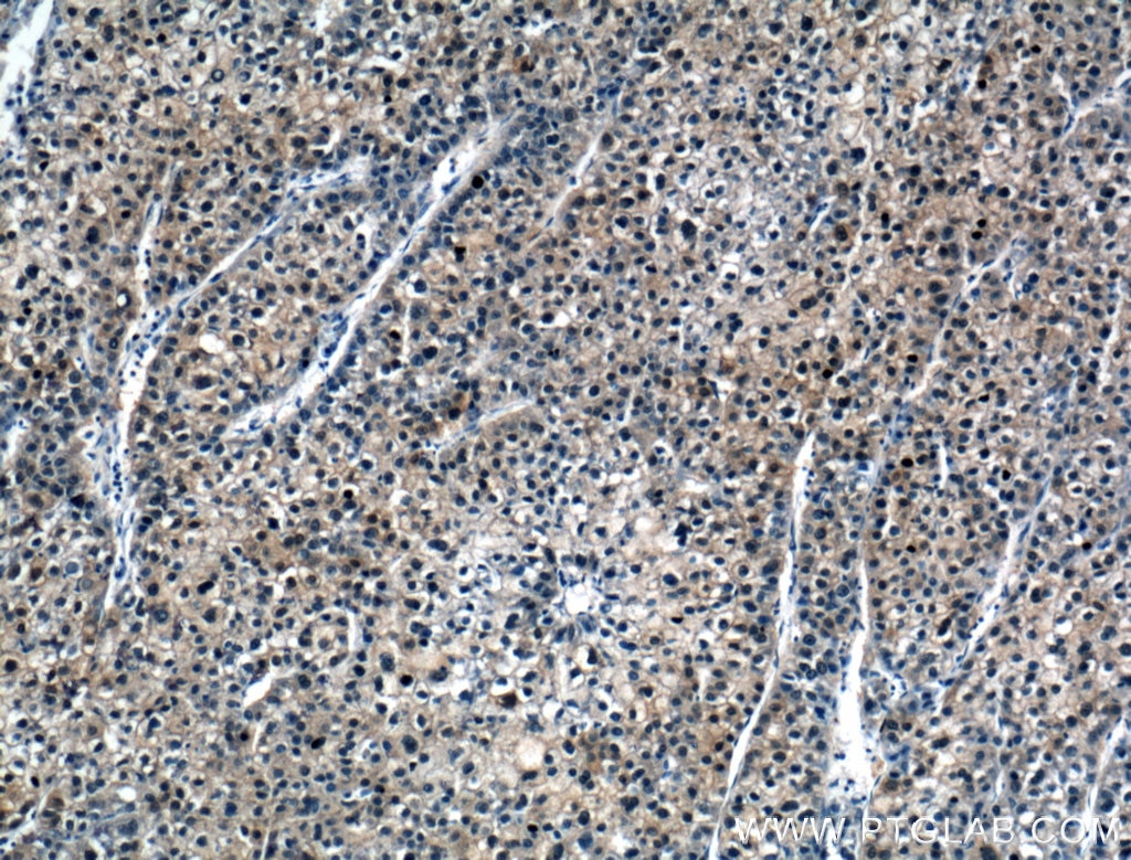 Immunohistochemistry (IHC) staining of human liver cancer tissue using ASL Polyclonal antibody (16645-1-AP)