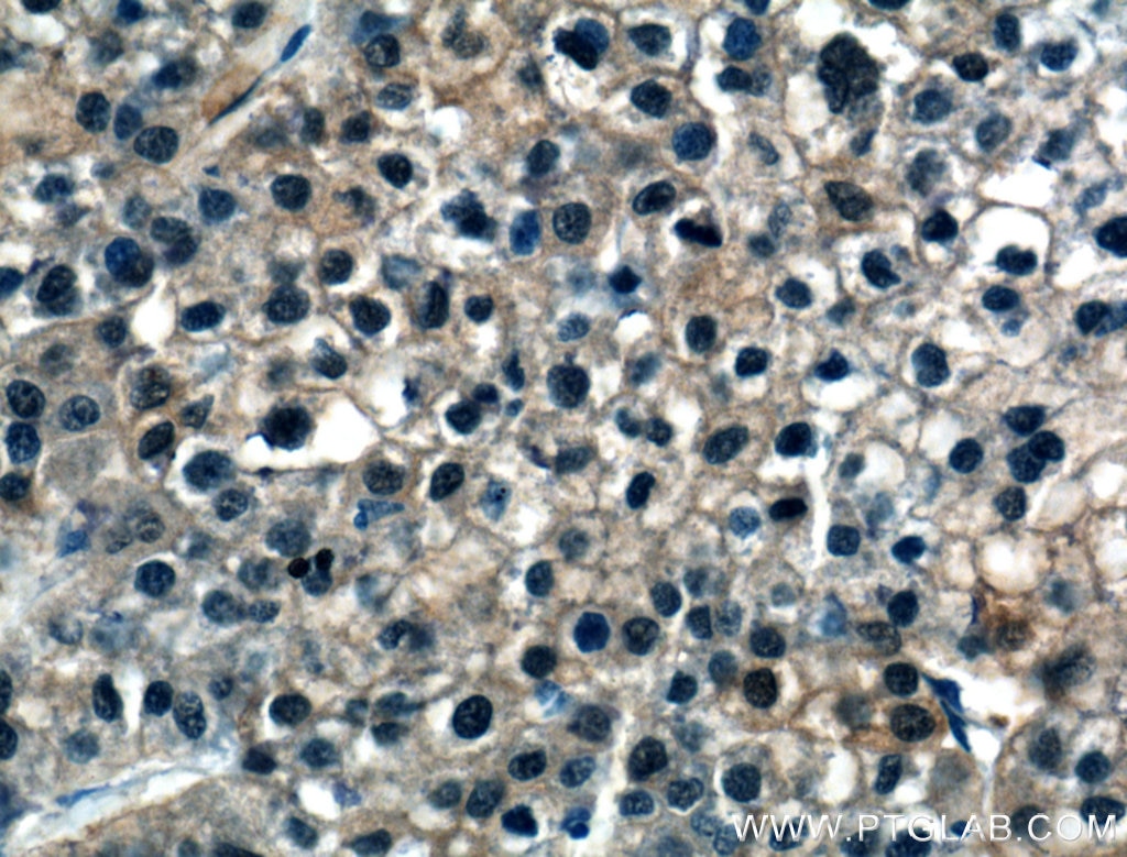 Immunohistochemistry (IHC) staining of human liver cancer tissue using ASL Polyclonal antibody (16645-1-AP)