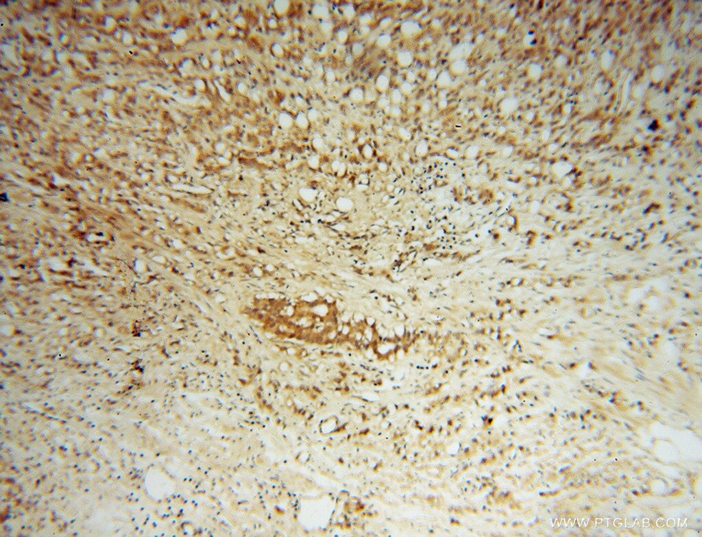 Immunohistochemistry (IHC) staining of human prostate cancer tissue using ASMTL Polyclonal antibody (14981-1-AP)