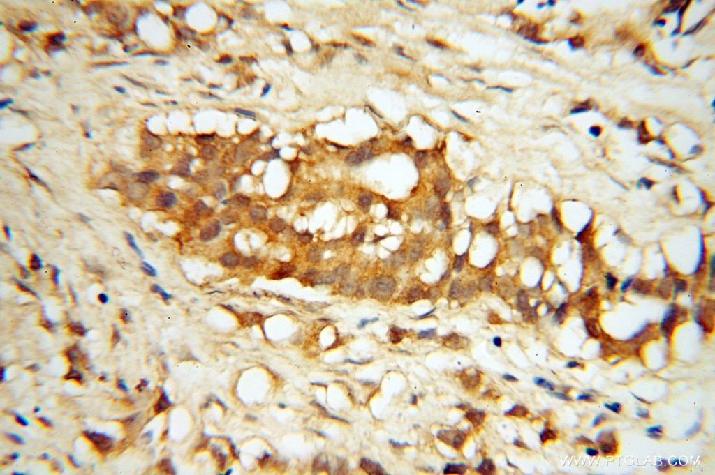Immunohistochemistry (IHC) staining of human prostate cancer tissue using ASMTL Polyclonal antibody (14981-1-AP)