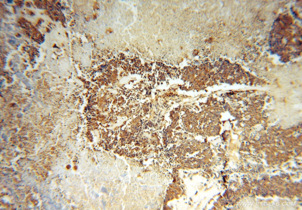 Immunohistochemistry (IHC) staining of human lung cancer tissue using ASNA1 Polyclonal antibody (15450-1-AP)