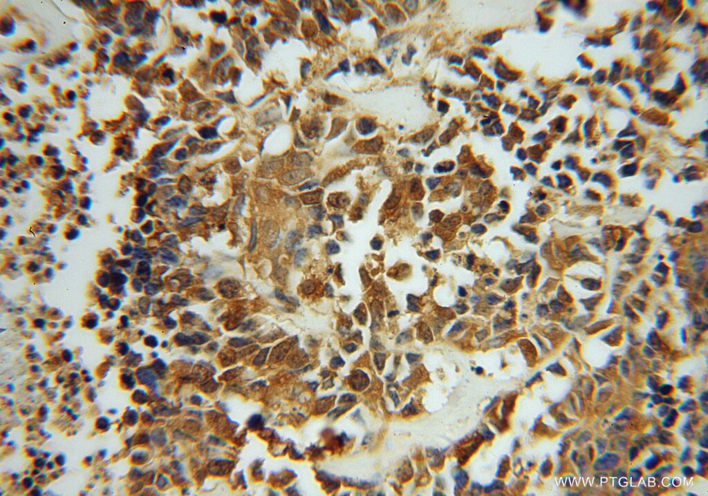 Immunohistochemistry (IHC) staining of human lung cancer tissue using ASNA1 Polyclonal antibody (15450-1-AP)