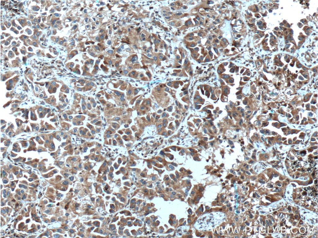 Immunohistochemistry (IHC) staining of human lung cancer tissue using ASNA1 Monoclonal antibody (66346-1-Ig)