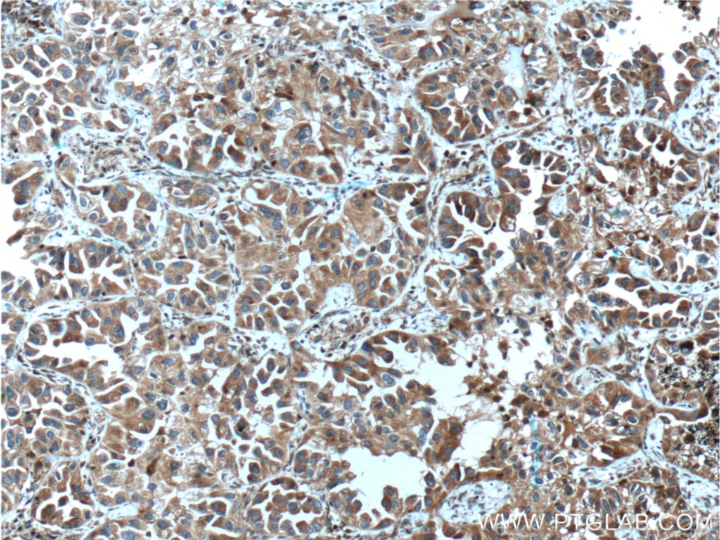 IHC staining of human lung cancer using 66346-1-Ig