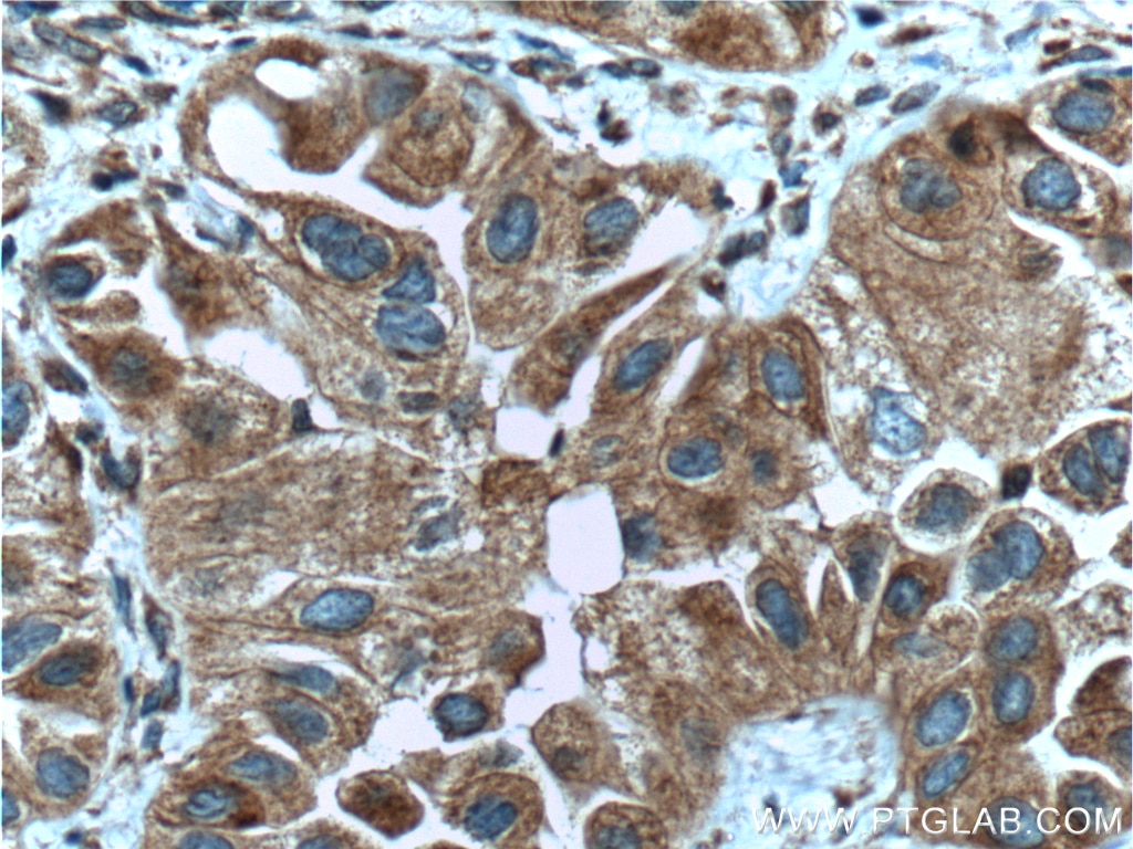 Immunohistochemistry (IHC) staining of human lung cancer tissue using ASNA1 Monoclonal antibody (66346-1-Ig)